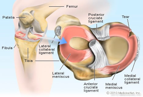 Picture of Torn Meniscus