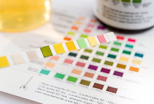 Urine tests for diabetes look for ketones in the urine.