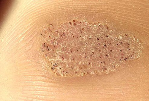Thickened areas on the soles of the feet that have small black spots or pinholes are likely plantar warts.