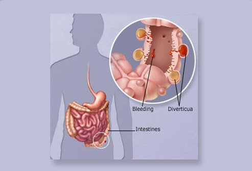 Most people in the U.S. over the age of 60 have diverticulosis, but very few have overt symptoms.