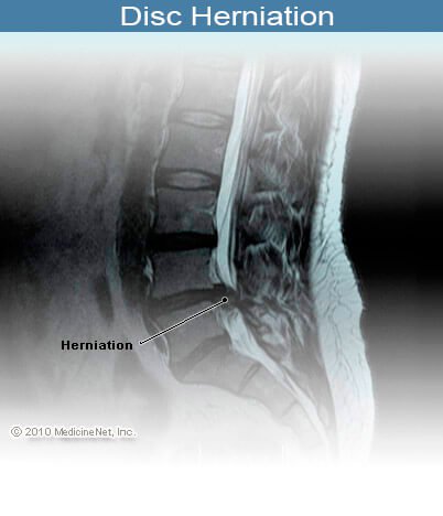 Picture of herniated disc between L4 and L5