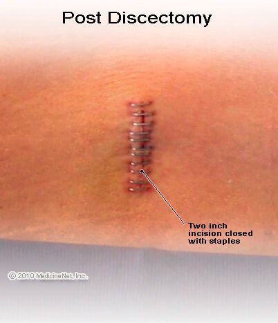 Post Discectomy