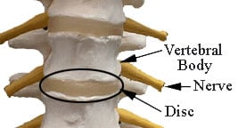 Picture of Vertebral Body, Nerve, and Disc
