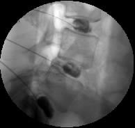 Picture of Discogram Using Fluoroscope