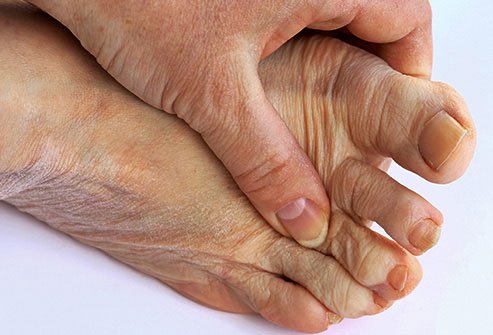 You might think of the Middle Ages when you think of this type of painful arthritis.