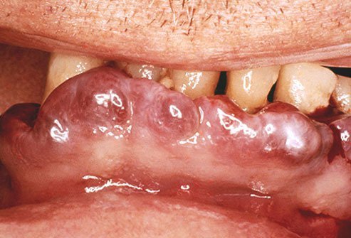 If you stop eating and drinking foods with vitamin C, within a month signs of scurvy can develop.