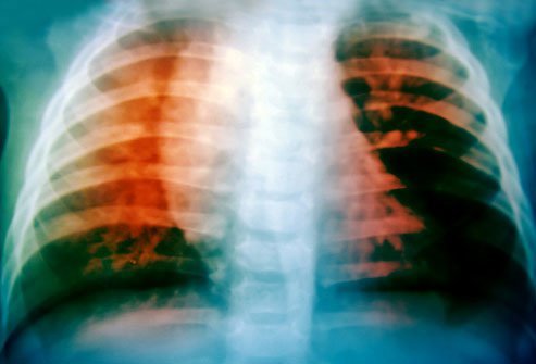 TB infections are now mainly confined to 30 countries, with India and China accounting for the most infections overall.