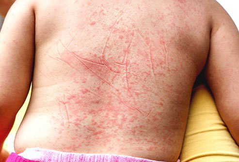 Scarlet fever usually appears in kids ages 5-15, but anyone can get this bacterial infection.