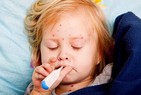 Before the vaccine was widely distributed in the late 20th century, nearly every child in America got the measles.