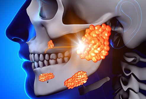 This viral disease is spread through saliva droplets, and causes fever, weakness, and characteristically swollen saliva glands.
