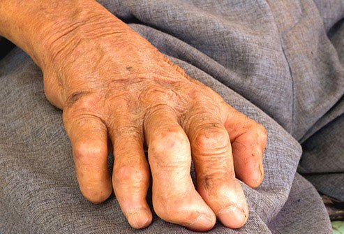 Leprosy is a disease reported in ancient times in places like Egypt, China, and India.