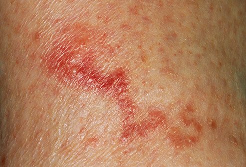 These enter your body through the skin