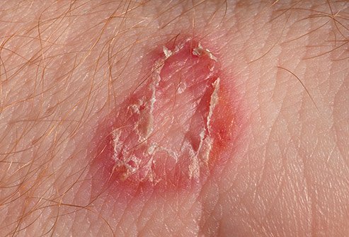 Dogs, cats, pigs, horses, and other animals can pass along this fungus when you touch them.