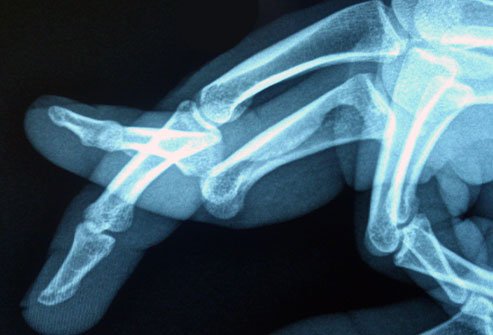 Deformity, swelling, and pain are signs and symptoms of a dislocated finger.