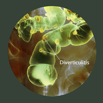 Colored X-ray of the colon of a patient with diverticulitis showing the small pouch-like structures that protrudes out of weak spots in the intestinal wall.