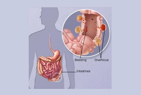 Diverticulitis