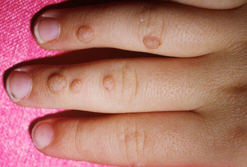 Photo of warts on hand.