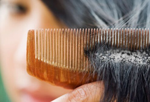 Photo of woman with dandruff.