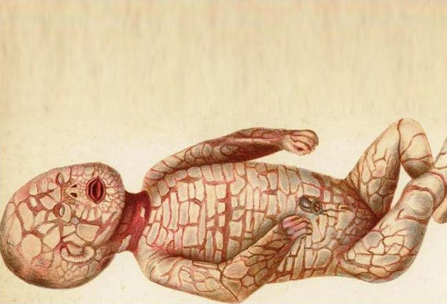 Harlequin ichthyosis is a rare congenital disease that affects the skin