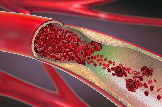 In the same study of 19 women, tart juice brought cholesterol levels down, which could cut your risk for heart disease.
