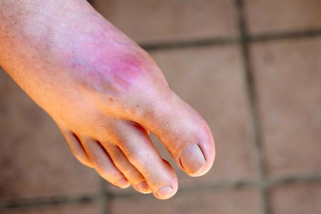 The idea that cherries might prevent attacks of gout has been around for decades.
