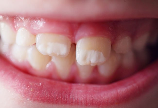white spots on teeth