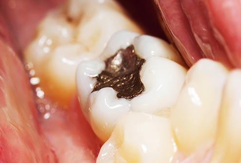 There's no link between mercury and other materials in fillings and cancer.