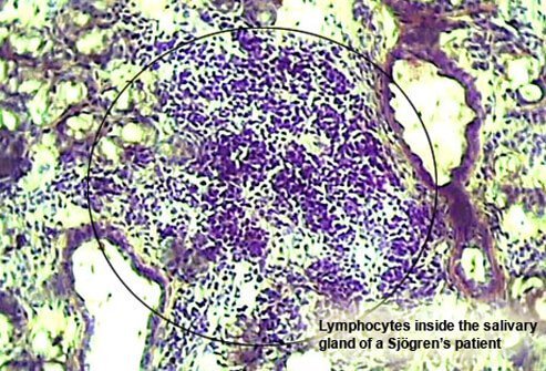 Sjögren's syndrome