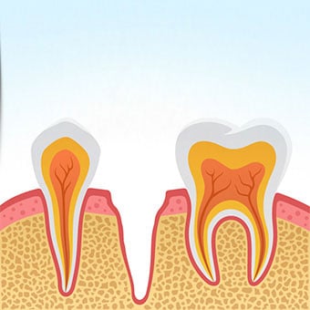 Dry sockets can be caused by bacterial, chemical, mechanical, or physiological factors.