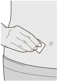 LS Mean Change
from Baseline in Bilateral Nasal Polyps Score (NPS) up to Week 48 in CSNP Trial
1 -ITT Population - Illustration