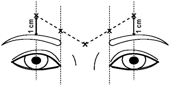 To inject DYSPORT, advance the needle through the skin
into the underlying muscle while applying finger pressure on the superior
medial orbital rim - Illustration