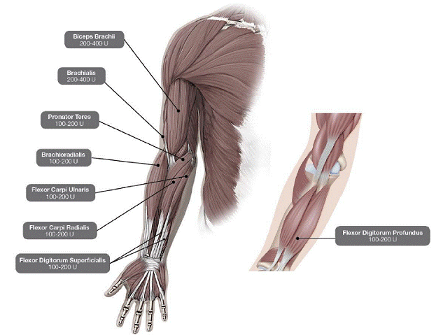 Muscles for Injection for Upper Limb
Spasticity in Adults - Illustration