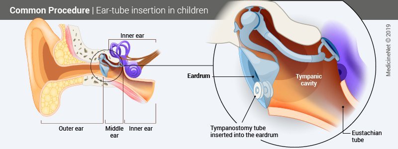 Diagram showing how ear tubes are surgically inserted