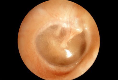 The diagnosis of an ear infection is made by examining the inside of the ear with an instrument called an otoscope.