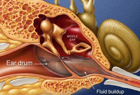 Inner Ear Infection (Labyrinthitis) 