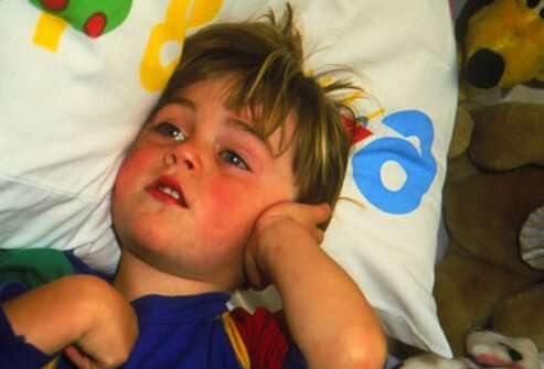 Eustachian Tube Dysfunction Symptoms