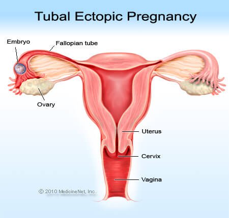 Picture of an ectopic or tubal pregnancy