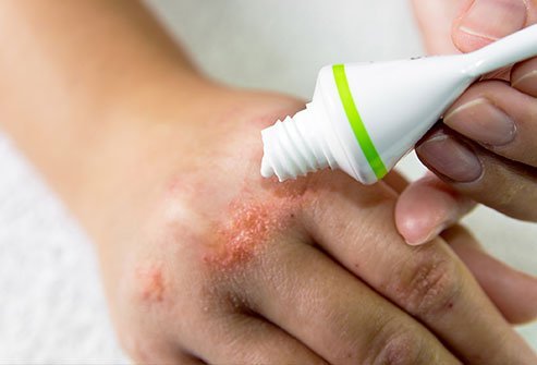 Eczema treatment can be complex. There are many types of eczema that all might need a different treatment. However, there may be some self-care and home care practices that you can do to manage your skin and your symptoms.