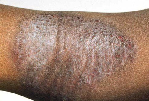 Eczema is a general term for many types of skin inflammation (dermatitis), with the most common form being atopic dermatitis.