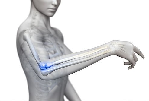 Signs and symptoms of a dislocated elbow include a visible deformity, pain, and swelling.