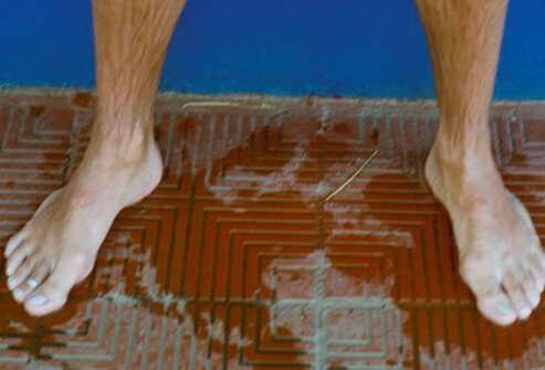 Athlete's foot (tinea pedis) is a fungal infection that affects the feet and toes, causing itchy, red, cracked, tender, and scaly skin.
