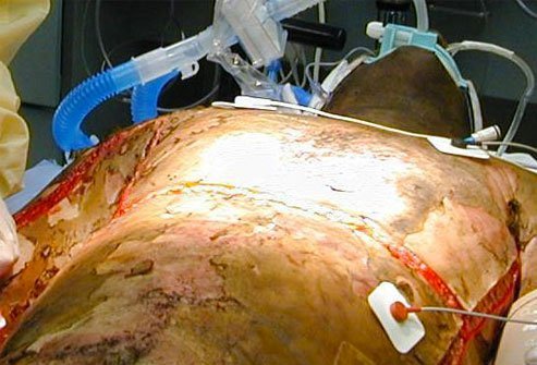 Escharotomy is performed to restore blood supply, to relieve pressure or to improve lung function.