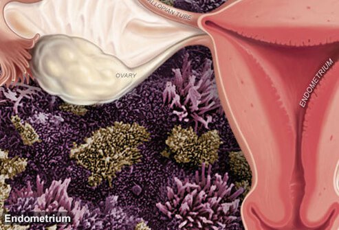 Picture of Endometriosis
