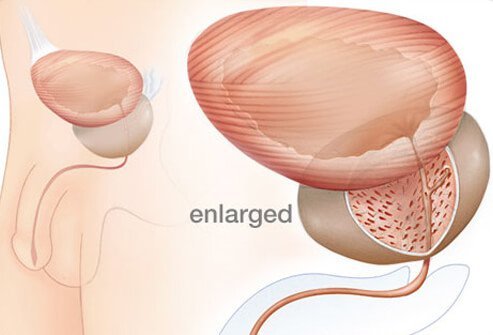The most common symptom of BPH includes having to urinate more, often at night.