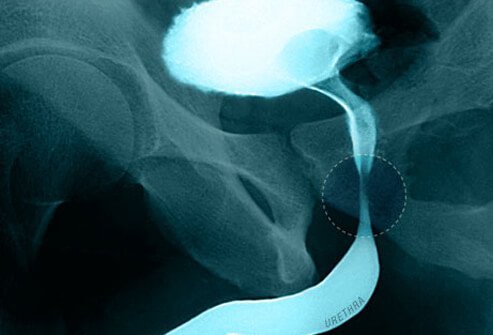 If BPH completely blocks the urethra, inability to urinate may result.