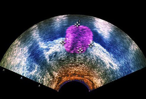 A presumptive diagnosis of BPH is based upon taking a history of your symptoms; other tests may be used to confirm the diagnosis.