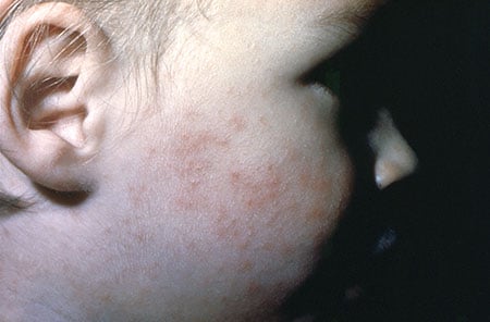 Picture of a rash on a child's face due to enterovirus (echovirus-9)
