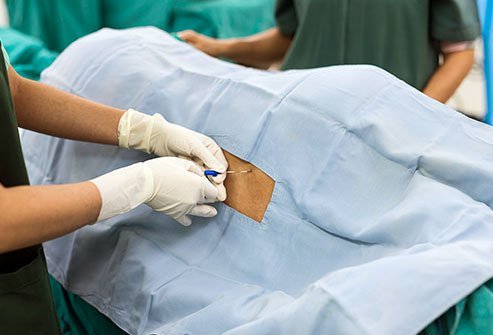 An epidural is a form of regional anesthesia that blocks pain in a particular region of the body. Most epidural side effects are rare and may include soreness, nausea, shivering, drop in blood pressure, ear ringing, difficulty urinating, backache and soreness.