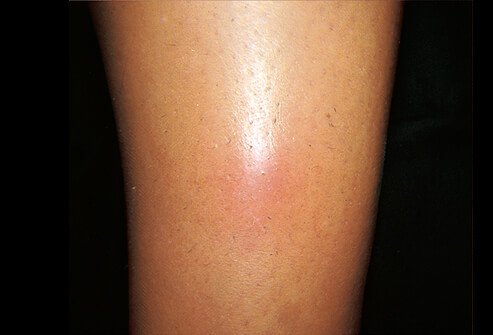 Picture of Erythema Nodosum