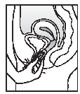 Gently push the compressed ring - Illustration